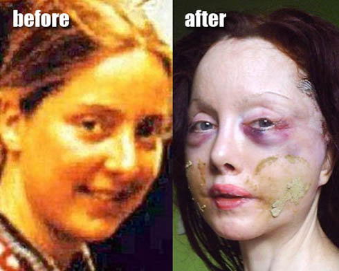 Слева: Нилен в возрасте 22-х лет, до того, как она решила стать реинкарнацией Нефертити. Справа - британка после очередной пластической операции. 