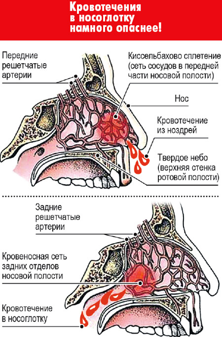 Носовое кроветечение